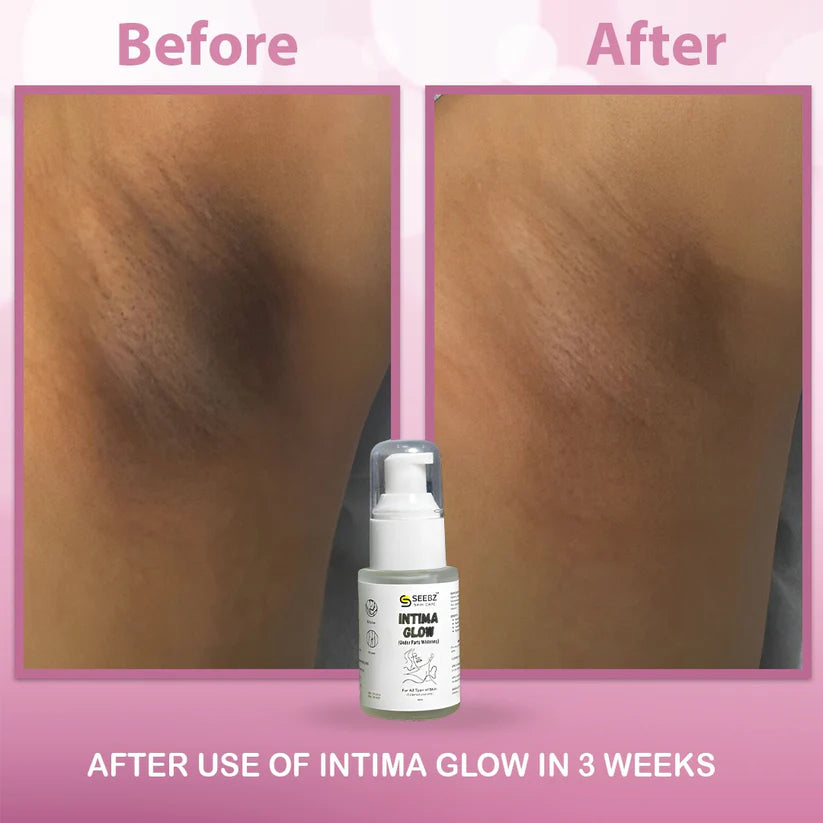 Intima Glow